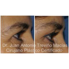 Blefaroplastia - Centro de Cirugía Plástica. Dr. Juan Antonio Treviño Macías