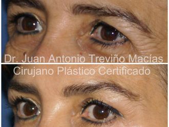 Blefaroplastia antes y después - 875554