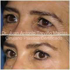 Blefaroplastia - Centro de Cirugía Plástica. Dr. Juan Antonio Treviño Macías