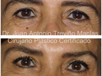 Blefaroplastia antes y después - 875555
