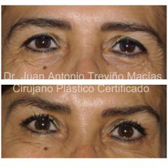 Blefaroplastia - Centro de Cirugía Plástica. Dr. Juan Antonio Treviño Macías