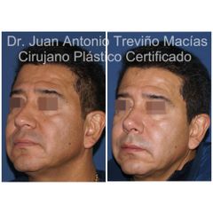 Rinoplastia - Centro de Cirugía Plástica. Dr. Juan Antonio Treviño Macías