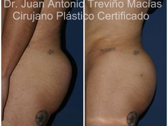 Gluteoplastia antes y después - 875558
