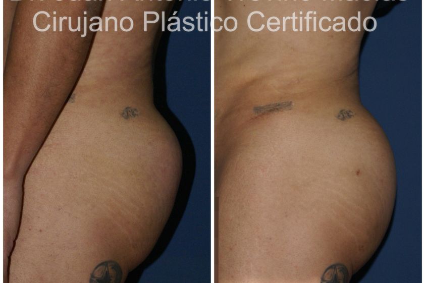 Gluteoplastia antes y después - 875558