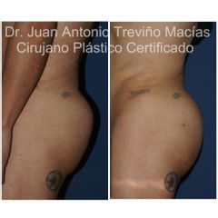 Gluteoplastia - Centro de Cirugía Plástica. Dr. Juan Antonio Treviño Macías