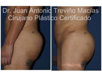 Gluteoplastia antes y después - 875559