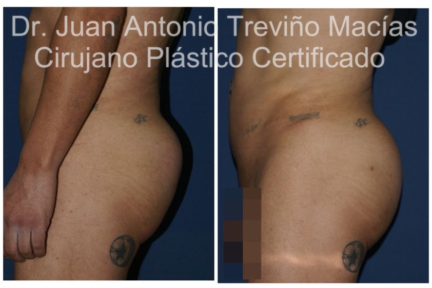Gluteoplastia antes y después - 875559
