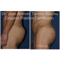 Gluteoplastia - Centro de Cirugía Plástica. Dr. Juan Antonio Treviño Macías