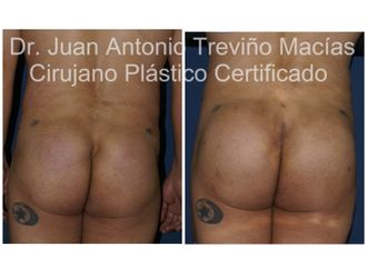 Gluteoplastia antes y después - 875560