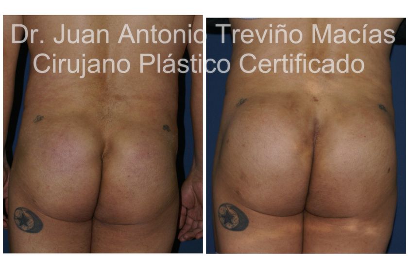 Gluteoplastia antes y después - 875560