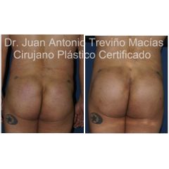Gluteoplastia - Centro de Cirugía Plástica. Dr. Juan Antonio Treviño Macías
