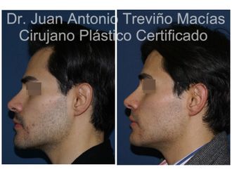 Cirugía facial antes y después - 875561