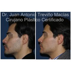 Cirugia Facial - Centro de Cirugía Plástica. Dr. Juan Antonio Treviño Macías