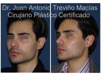 Cirugía facial antes y después - 875562