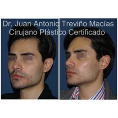Cirugia Facial - Centro de Cirugía Plástica. Dr. Juan Antonio Treviño Macías