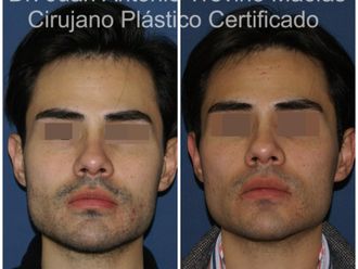 Cirugía facial antes y después - 875563