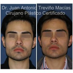 Cirugia Facial - Centro de Cirugía Plástica. Dr. Juan Antonio Treviño Macías