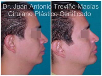 Mentoplastia antes y después - 875564
