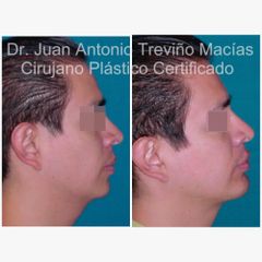 Mentoplastia - Centro de Cirugía Plástica. Dr. Juan Antonio Treviño Macías