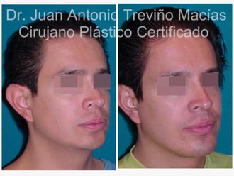 Mentoplastia antes y después - 875565