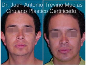 Mentoplastia antes y después - 875566