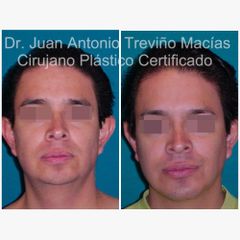 Mentoplastia - Centro de Cirugía Plástica. Dr. Juan Antonio Treviño Macías