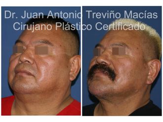 Cirugía facial antes y después - 875567