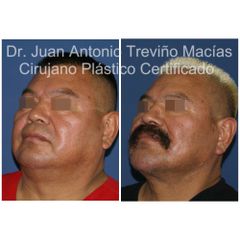 Cirugia Facial - Centro de Cirugía Plástica. Dr. Juan Antonio Treviño Macías