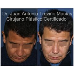Rinoplastia - Centro de Cirugía Plástica. Dr. Juan Antonio Treviño Macías