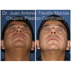Rinoplastia - Centro de Cirugía Plástica. Dr. Juan Antonio Treviño Macías