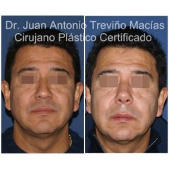 Rinoplastia - Centro de Cirugía Plástica. Dr. Juan Antonio Treviño Macías