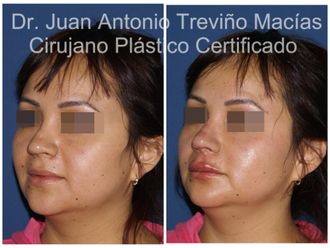 Ácido hialurónico antes y después - 875610