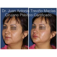 Rinoplastia - Centro de Cirugía Plástica. Dr. Juan Antonio Treviño Macías