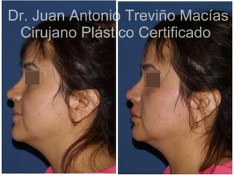Ácido hialurónico antes y después - 875611