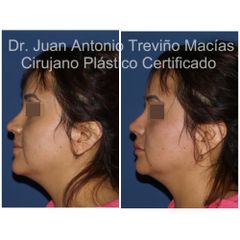 Ácido Hialurónico - Centro de Cirugía Plástica. Dr. Juan Antonio Treviño Macías