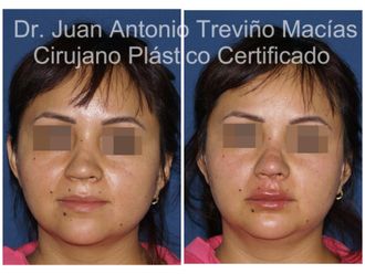Ácido hialurónico antes y después - 875612