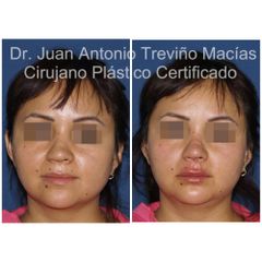 Ácido Hialurónico - Centro de Cirugía Plástica. Dr. Juan Antonio Treviño Macías