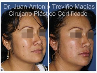 Ácido hialurónico antes y después - 875613