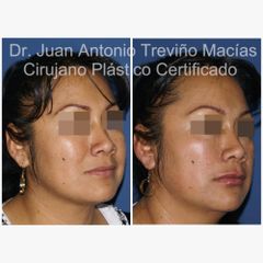 Ácido Hialurónico - Centro de Cirugía Plástica. Dr. Juan Antonio Treviño Macías