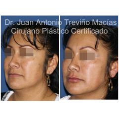 Ácido Hialurónico - Centro de Cirugía Plástica. Dr. Juan Antonio Treviño Macías