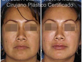 Ácido hialurónico antes y después - 875615