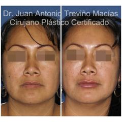 Ácido Hialurónico - Centro de Cirugía Plástica. Dr. Juan Antonio Treviño Macías