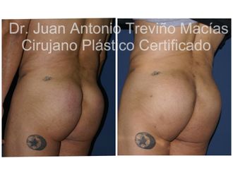 Gluteoplastia antes y después - 875616