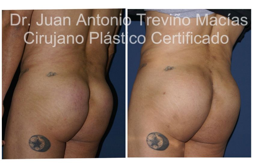 Gluteoplastia antes y después - 875616