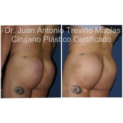 Gluteoplastia - Centro de Cirugía Plástica. Dr. Juan Antonio Treviño Macías