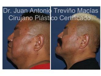 Cirugía facial antes y después - 875617
