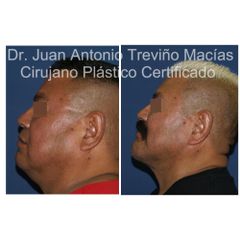 Cirugia Facial - Centro de Cirugía Plástica. Dr. Juan Antonio Treviño Macías