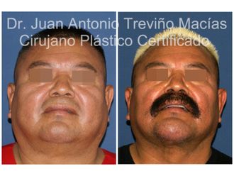 Cirugía facial antes y después - 875618
