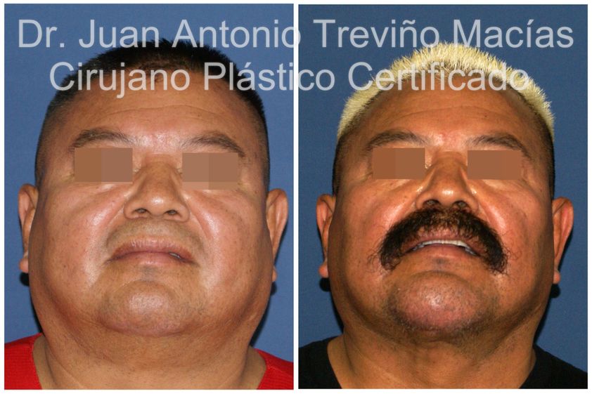 Cirugía facial antes y después - 875618