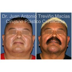 Cirugia Facial - Centro de Cirugía Plástica. Dr. Juan Antonio Treviño Macías